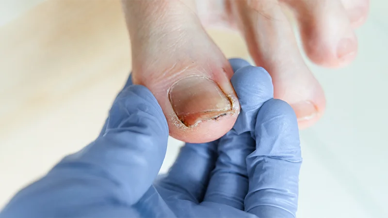 close-up of a healthcare professional wearing blue gloves examining a patient's bruised and damaged toenail.